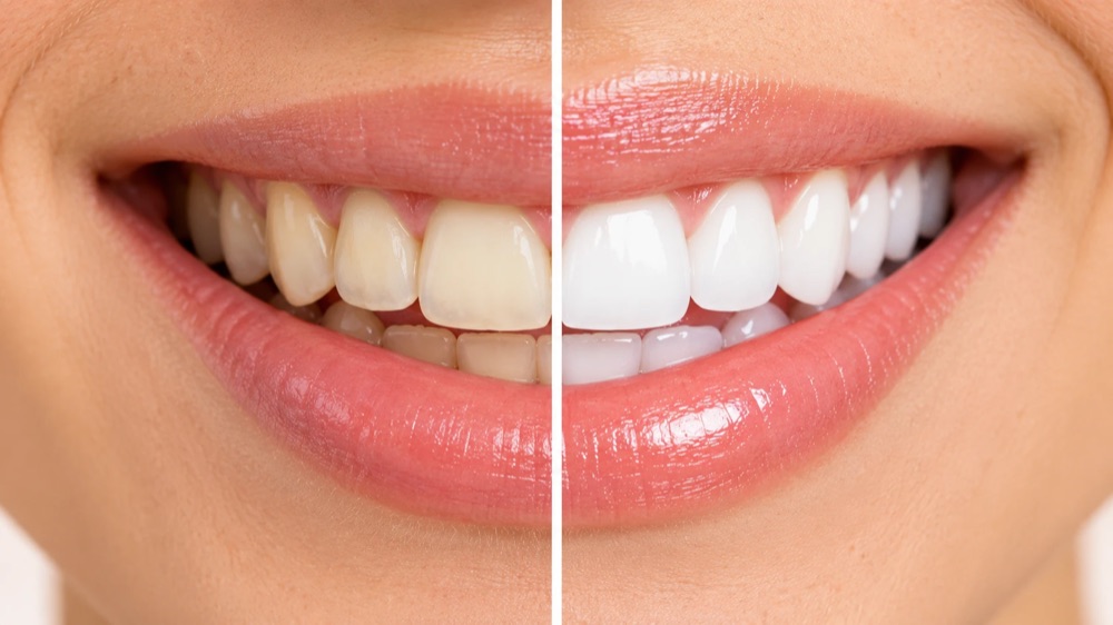 Comparación ilustrativa de sonrisa antes y después de un blanqueamiento dental
